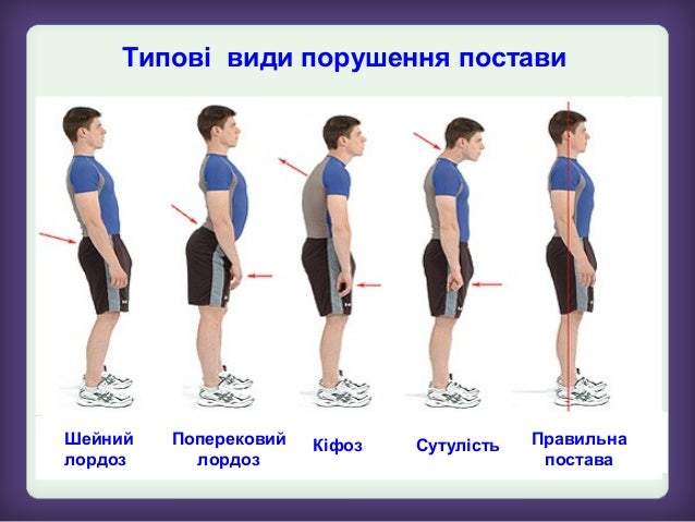 Порушення постави у дошкільнят. Лікар розповідає про порушення постави у дітей - YouTube Презентация на тему: "Фізіолого-гігієнічні аспекти організації навчання. Порушення постави.Модуль гімнастика - YouTube