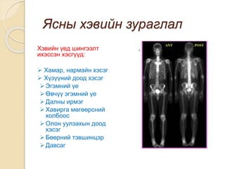 остеосцинтиграфи | PPT