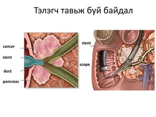 Тэлэгч тавьж буй байдал
cancer
stent
duct
pancreas
stent
scope
 