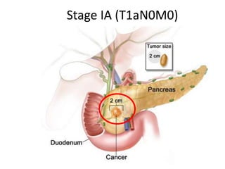 Stage IA (T1aN0M0)
 