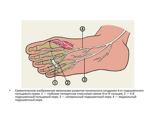 • Схематическое изображение механизма развития туннельного синдрома 4-го подошвенного
пальцевого нерва: 1 — глубокая поперечная плюсневая связка III и IV пальцев; 2 — 4-й
подошвенный пальцевый нерв; 3 — латеральный подошвенный нерв; 4 — медиальный
подошвенный нерв.
 