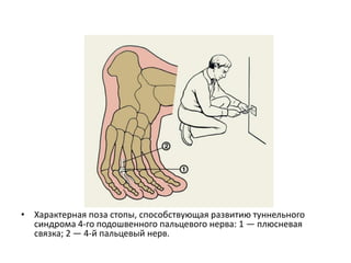 • Характерная поза стопы, способствующая развитию туннельного
синдрома 4-го подошвенного пальцевого нерва: 1 — плюсневая
связка; 2 — 4-й пальцевый нерв.
 