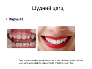 • Харьцаа:
Шүдний цөгц
Сүүн шүд нь намхан, медиал дистал талын гадаргуу өргөн пагдгар
Мөн цөгцний өндөртэй харьцуулхад сурвалж нь урт бна.
 