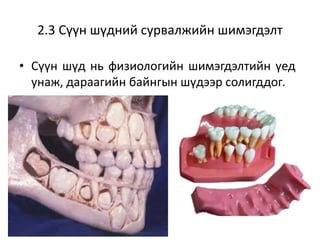 2.3 Сүүн шүдний сурвалжийн шимэгдэлт
• Сүүн шүд нь физиологийн шимэгдэлтийн үед
унаж, дараагийн байнгын шүдээр солигддог.
 