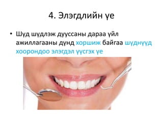 4. Элэгдлийн үе
• Шүд шүдлэж дууссаны дараа үйл
ажиллагааны дүнд хоршиж байгаа шүднүүд
хоорондоо элэгдэл үүсгэх үе
 