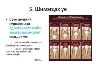 5. Шимэгдэх үе
• Сүүн шүдний
сурвалжинд
одонтокласт эсийн
улмаас шимэгдэлт
явагдах үе.
физиологийн- шимэгдэх
ёстой цагтаа шимэгдэнэ
Эмгэг- шимэгдэх ёстой
цагаасаа эрт, хожуу, огт
шимэгдэхгүй
байх...
 