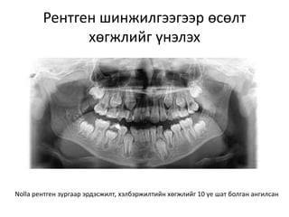 Рентген шинжилгээгээр өсөлт
хөгжлийг үнэлэх
Nolla рентген зургаар эрдэсжилт, хэлбэржилтийн хөгжлийг 10 үе шат болган ангилсан
 