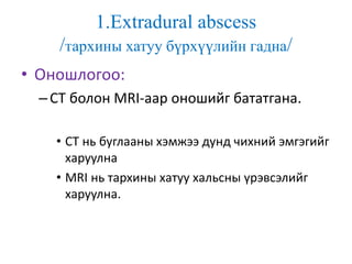 1.Extradural abscess
/тархины хатуу бүрхүүлийн гадна/
• Оношлогоо:
–CT болон MRI-аар оношийг бататгана.
• CT нь буглааны хэмжээ дунд чихний эмгэгийг
харуулна
• MRI нь тархины хатуу хальсны үрэвсэлийг
харуулна.
 