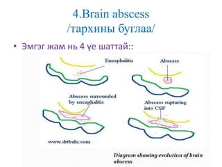 4.Brain abscess
/тархины буглаа/
• Эмгэг жам нь 4 үе шаттай::
 