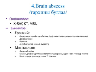 4.Brain abscess
/тархины буглаа/
• Оношлогоо:
• X-RAY, CT, MRI,
– эмчилгээ:
• Ерөнхий:
– Өндөр зэрэглэлийн антибиотик /цефтриаксон+метронидазол+гентамицин/
– Дексамитазон
– Пенитон
– Антибиотиктой чихний дусаалга
• Мэс заслын:
– Яаралтай хийнэ
– Гавлын дунд хөндийг нээж Голомтыг цэвэрлэнэ, идээг нээж гоожуур тавина
– Идээ татрсан үед шарх хаана. 7-10 хоног
 