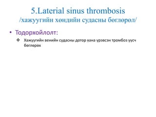 5.Laterial sinus thrombosis
/хажуугийн хөндийн судасны бөглөрөл/
• Тодорхойлолт:
 Хажуугийн венийн судасны дотор хана үрэвсэн тромбоз үүсч
бөглөрөх
 