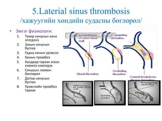 5.Laterial sinus thrombosis
/хажуугийн хөндийн судасны бөглөрөл/
• Эмгэг физиологи:
1. Тахир синусын хана
элэгдэнэ
2. Захын синусын
буглаа
3. Гадна ханын үрэвсэл
4. Ханын тромбоз
5. Халдвар тархах эсвэл
хэмжээ нэмэгдэх
6. Синусын люмен
бөглөрөл
7. Дотор синусын
буглаа
8. Үрэвслийн тромбоз
тархах
 