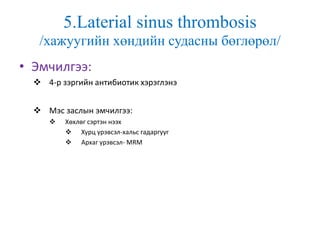5.Laterial sinus thrombosis
/хажуугийн хөндийн судасны бөглөрөл/
• Эмчилгээ:
 4-р зэргийн антибиотик хэрэглэнэ
 Мэс заслын эмчилгээ:
 Хөхлөг сэртэн нээх
 Хурц үрэвсэл-хальс гадаргууг
 Архаг үрэвсэл- MRM
 