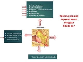 Дээш
урагшдоош
Үрэвсэл хаашаа
тархвал ямар
хүндрэл
болох вэ?
 