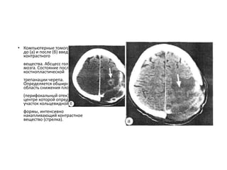• Компьютерные томограммы
до (а) и после (б) введения
контрастного
вещества. Абсцесс головного
мозга. Состояние после
костнопластической
трепанации черепа.
Определяется обширная
область снижения плотности
(перифокальный отек), в
центре которой определяется
участок кольцевидной
формы, интенсивно
накапливающий контрастное
вещество (стрелка).
 