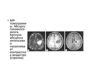 • MP-
томограмм
ы. Абсцесс
головного
мозга.
Капсула
абсцесса
интенсивн
о
накаплива
ет
контрастно
е вещество
(стрелки)
 