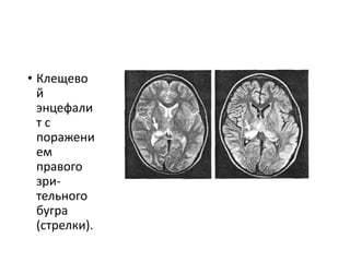 • Клещево
й
энцефали
т с
поражени
ем
правого
зри-
тельного
бугра
(стрелки).
 