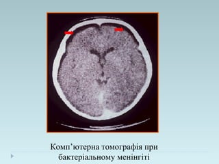 Комп’ютерна томографія при
бактеріальному менінгіті
 