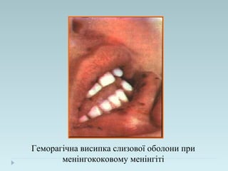 Геморагічна висипка слизової оболони при
менінгококовому менінгіті
 