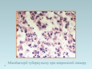Мікобактерії туберкульозу при мікроскопії ліквору
 