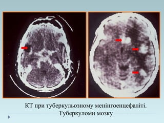 КТ при туберкульозному менінгоенцефаліті.
Туберкуломи мозку
 