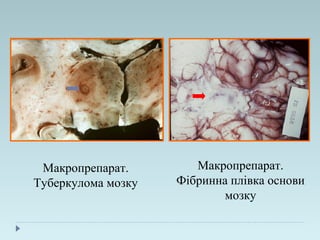 Макропрепарат.
Туберкулома мозку
Макропрепарат.
Фібринна плівка основи
мозку
 