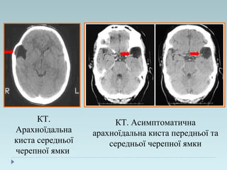 КТ.
Арахноїдальна
киста середньої
черепної ямки
КТ. Асимптоматична
арахноїдальна киста передньої та
середньої черепної ямки
 