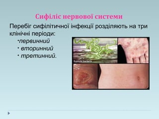 Сифіліс нервової системи
Перебіг сифілітичної інфекції розділяють на три
клінічні періоди:
•первинний
• вторинний
• третинний.
 