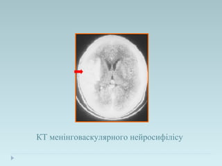 КТ менінговаскулярного нейросифілісу
 