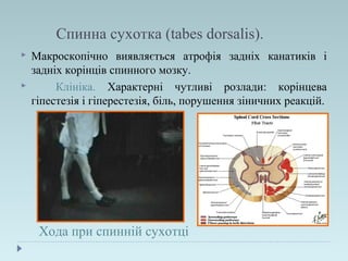 Спинна сухотка (tabes dorsalis).
 Макроскопічно виявляється атрофія задніх канатиків і
задніх корінців спинного мозку.
 Клініка. Характерні чутливі розлади: корінцева
гіпестезія і гіперестезія, біль, порушення зіничних реакцій.
Хода при спинній сухотці
 
