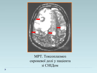 МРТ. Токсоплазмоз
скроневої долі у паціента
зі СНІДом
 