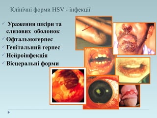 Клінічні форми HSV - інфекції
 Ураження шкіри та
слизових оболонок
 Офтальмогерпес
 Генітальний герпес
 Нейроінфекція
 Вісцеральні форми
 