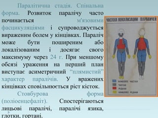 Паралітична стадія. Спінальна
форма. Розвиток паралічу часто
починається м'язовими
фасцикуляціями і супроводжується
вираженим болем у кінцівках. Параліч
може бути поширеним або
локалізованим і досягає свого
максимуму через 24 г. При меншому
обсязі ураження на перший план
виступає асиметричний “плямистий”
характер паралічів. У вражених
кінцівках сповільнюється ріст кісток.
Стовбурова форма
(поліоенцефаліт). Спостерігаються
лицьові паралічі, паралічі язика,
глотки, гортані.
 