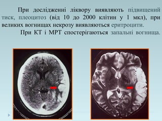 При дослідженні ліквору виявляють підвищений
тиск, плеоцитоз (від 10 до 2000 клітин у 1 мкл), при
великих вогнищах некрозу виявляються еритроцити.
При КТ і МРТ спостерігаються запальні вогнища.
 