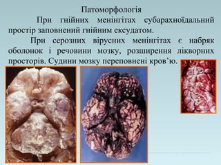 Патоморфологія
При гнійних менінгітах субарахноїдальний
простір заповнений гнійним ексудатом.
При серозних вірусних менінгітах є набряк
оболонок і речовини мозку, розширення лікворних
просторів. Судини мозку переповнені кров’ю.
 