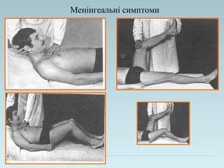 Менінгеальні симптоми
 