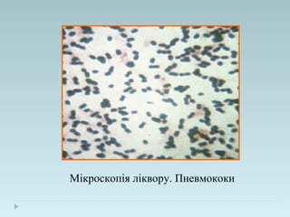 Мікроскопія ліквору. Пневмококи
 