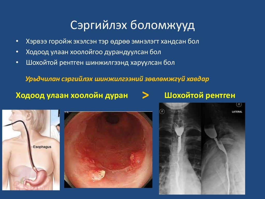 Хавдрын эрт илрүүлэг, оношилгоо