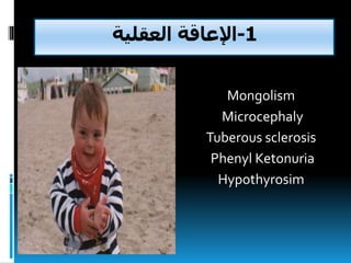 1-‫العقلية‬ ‫اإلعاقة‬
Mongolism
Microcephaly
Tuberous sclerosis
Phenyl Ketonuria
Hypothyrosim
 