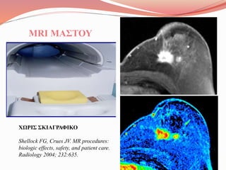 ΧΩΡΙΣ ΣΚΙΑΓΡΑΦΙΚΟ
Shellock FG, Crues JV. MR procedures:
biologic effects, safety, and patient care.
Radiology 2004; 232:635.
MRI ΜΑΣΤΟΥ
 