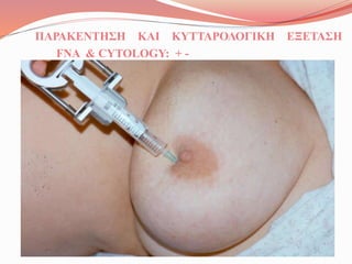 ΠΑΡΑΚΕΝΤΗΣΗ ΚΑΙ ΚΥΤΤΑΡΟΛΟΓΙΚΗ ΕΞΕΤΑΣΗ
FNA & CYTOLOGY: + -
 