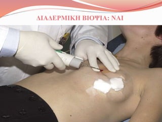 ΔΙΑΔΕΡΜΙΚΗ ΒΙΟΨΙΑ: ΝΑΙ
 
