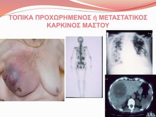 ΤΟΠΙΚΑ ΠΡΟΧΩΡΗΜΕΝΟΣ ή ΜΕΤΑΣΤΑΤΙΚΟΣ
ΚΑΡΚΙΝΟΣ ΜΑΣΤΟΥ
 