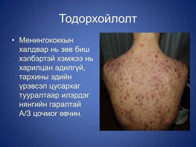 гар, хөл, амны өвчин | PPT