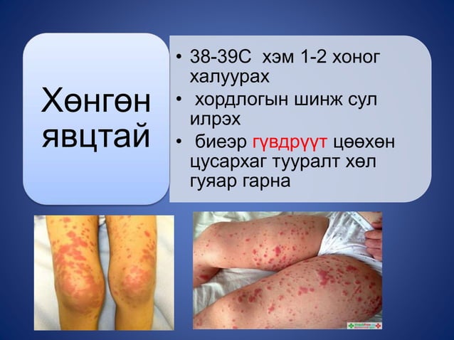 гар, хөл, амны өвчин | PPT