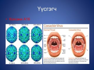 Үүсгэгч
• Коксаки А16
 