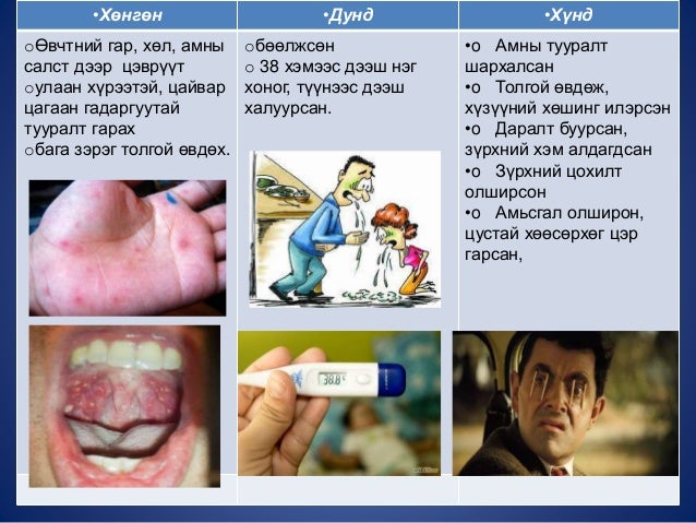 гар, хөл, амны өвчин