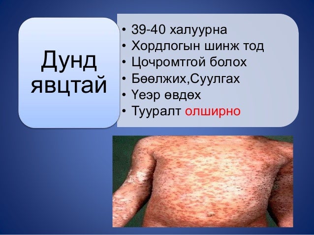 гар, хөл, амны өвчин