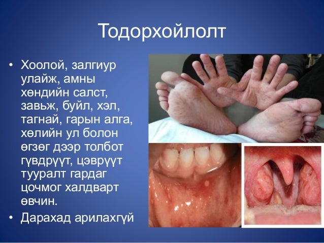 гар, хөл, амны өвчин