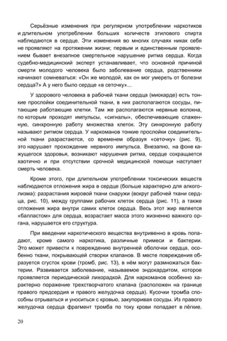 20
Серьёзные изменения при регулярном употреблении наркотиков
и длительном употреблении больших количеств этилового спирта
наблюдаются в сердце. Эти изменения во многих случаях никак себя
не проявляют на протяжении жизни; первым и единственным проявле-
нием бывает внезапное смертельное нарушение ритма сердца. Когда
судебно-медицинский эксперт устанавливает, что основной причиной
смерти молодого человека было заболевание сердца, родственники
начинают сомневаться: «Он же молодой, как он мог умереть от болезни
сердца?» А у него было сердце «в сеточку»...
У здорового человека в рабочей ткани сердца (миокарде) есть тон-
кие прослойки соединительной ткани, в них располагаются сосуды, пи-
тающие работающие клетки. Там же располагаются нервные волокна,
по которым проходят импульсы, «сигналы», обеспечивающие слажен-
ную, синхронную работу множества клеток. Эту синхронную работу
называют ритмом сердца. У наркоманов тонкие прослойки соединитель-
ной ткани разрастаются, со временем образуя «сеточку» (рис. 9),
это нарушает прохождение нервного импульса. Внезапно, на фоне ка-
жущегося здоровья, возникают нарушения ритма, сердце сокращается
хаотично и при отсутствии срочной медицинской помощи наступает
смерть человека.
Кроме этого, при длительном употреблении токсических веществ
наблюдаются отложения жира в сердце (больше характерно для алкого-
лизма): разрастания жировой ткани снаружи (вокруг рабочей ткани серд-
ца, рис. 10), между группами рабочих клеток сердца (рис. 11), а также
отложения жира внутри самих клеток сердца. Весь этот жир является
«балластом» для сердца, возрастает масса этого жизненно важного ор-
гана, нарушается его структура.
При введении наркотического вещества внутривенно в кровь попа-
дают, кроме самого наркотика, различные примеси и бактерии.
Это может привести к повреждению внутренней оболочки сердца, осо-
бенно ткани, покрывающей створки клапанов. В месте повреждения об-
разуется сгусток крови (тромб, рис. 13), в нём могут размножаться бак-
терии. Развивается заболевание, называемое эндокардитом, которое
проявляется периодической лихорадкой. Для наркоманов особенно ха-
рактерно поражение трехстворчатого клапана (расположен на границе
правого предсердия и правого желудочка сердца). Кусочки тромба спо-
собны отрываться и уноситься с кровью, закупоривая сосуды. Из правого
желудочка сердца фрагмент тромба по току крови попадает в лёгкие.
 